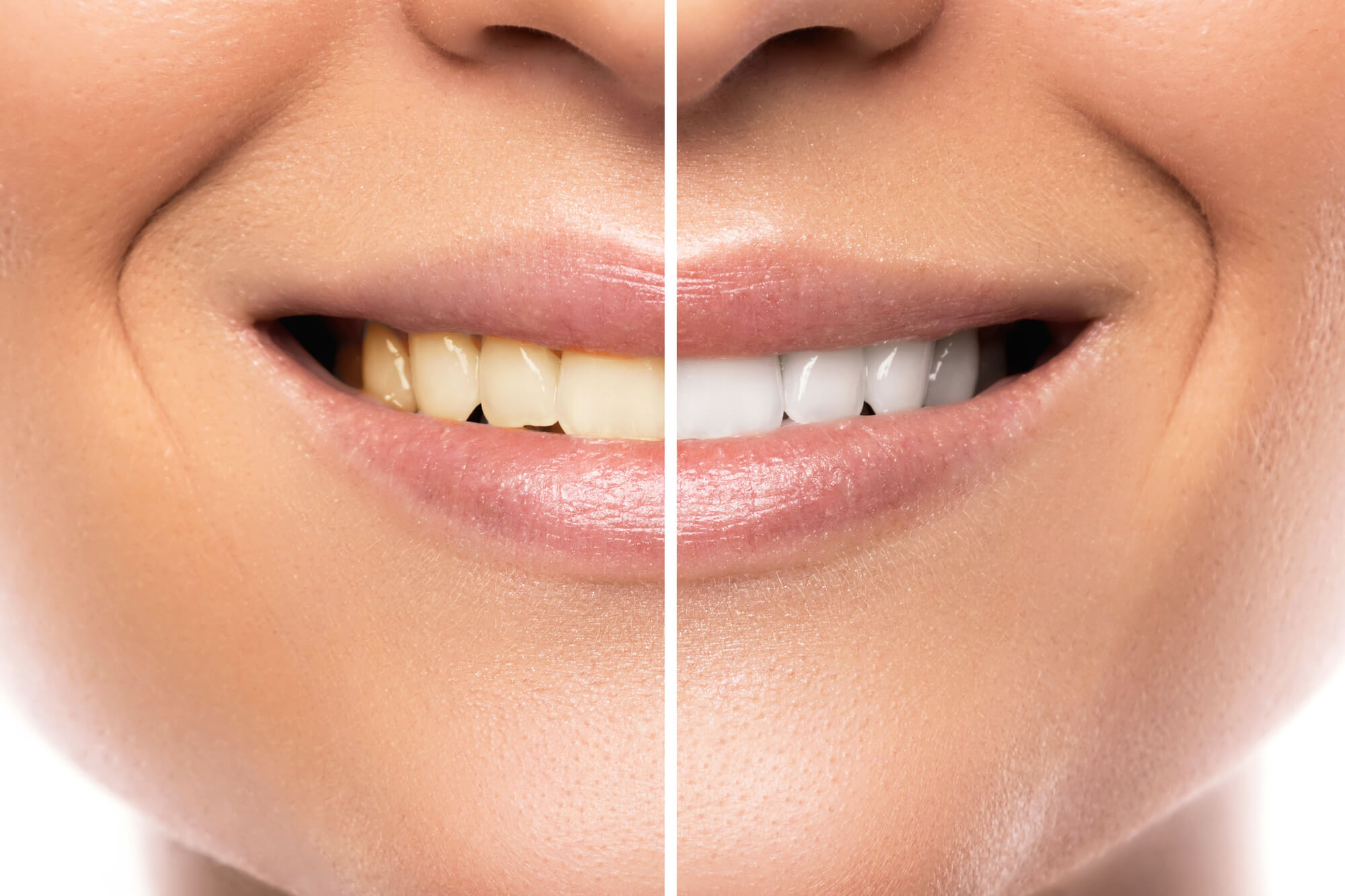 10 Benefits of Professional Teeth Whitening Near Me - Wellington Dentistry