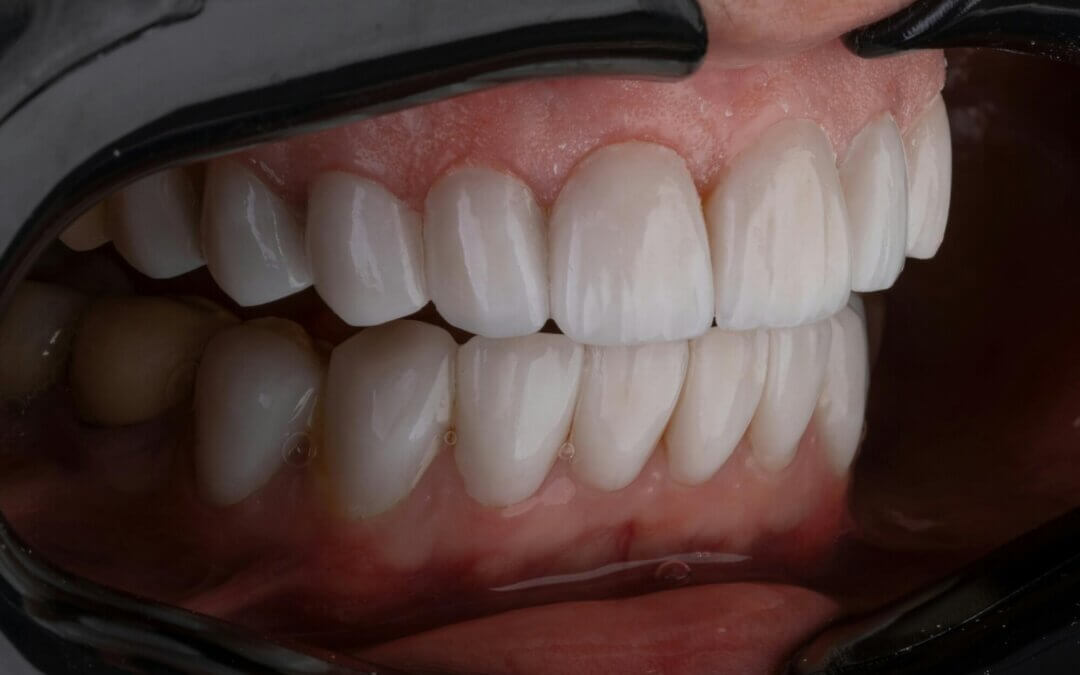 Veneers Longevity: Are They a Permanent Solution for Your Smile?