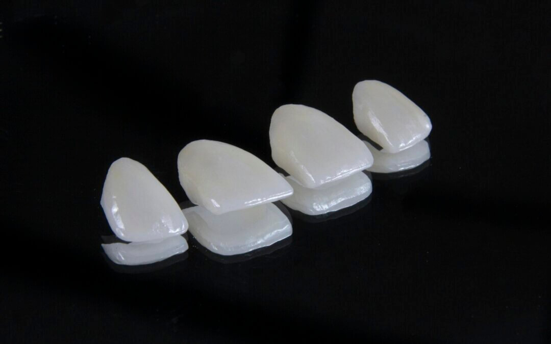 do veneers hurt