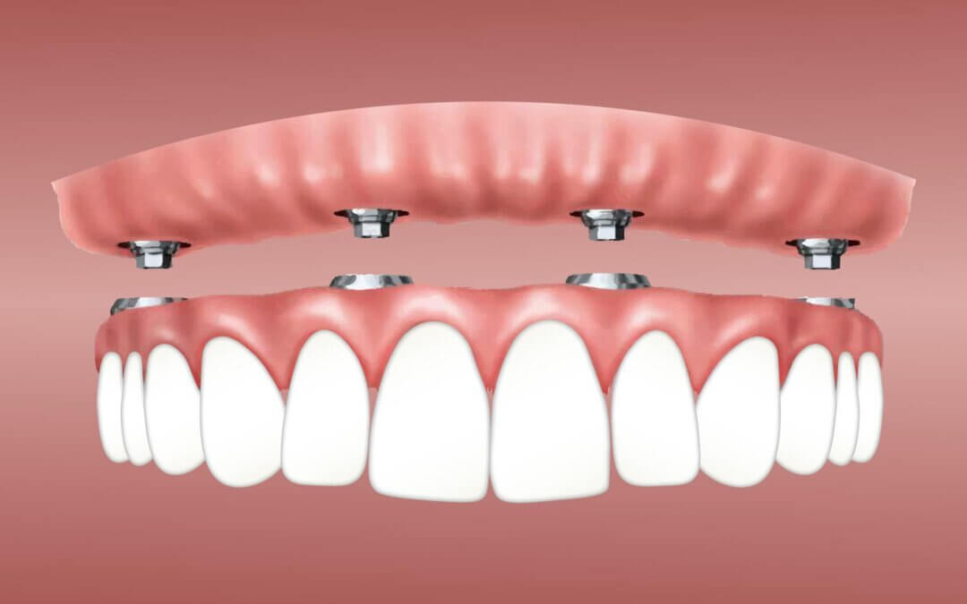 Dental Implants vs. Crowns: Which Dental Solution Suits You Best?