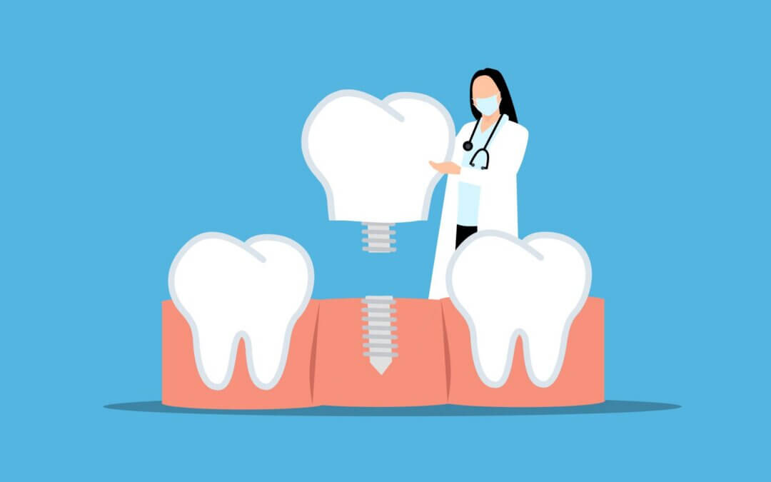 Dental Crowns in Lexington: What Are the Best Materials?